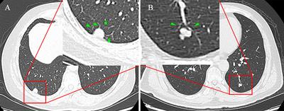 A comprehensive nomogram combining CT-based radiomics with clinical features for differentiation of benign and malignant lung subcentimeter solid nodules
